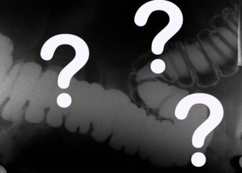 Some doctors got worse at detecting cancer after relying on AI