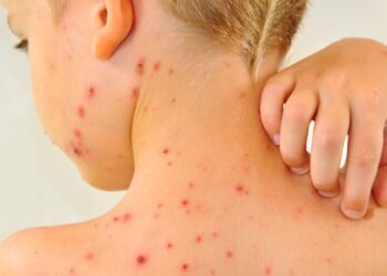 Chickenpox vaccine to be offered on NHS next year, as part of routine MMR jab for babies | Science, Climate & Tech News