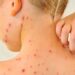 Chickenpox vaccine to be offered on NHS next year, as part of routine MMR jab for babies | Science, Climate & Tech News