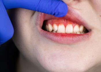 Natural Plant Compound Shows Promise for Treating Gum Disease