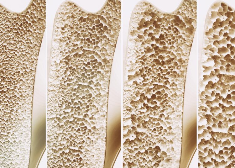 The Newly Found Bone Switch That Could Stop Osteoporosis
