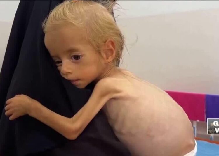 Toddler evacuated from Gaza recovers from malnutrition in Italian hospital