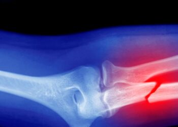 Microplastics Could Be Weakening Your Bones, Research Suggests