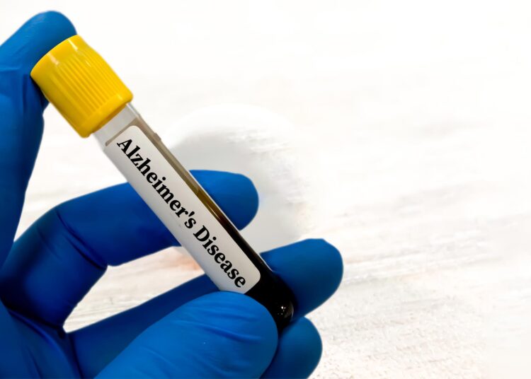 New Blood Test Predicts When Alzheimer’s Symptoms Will Begin