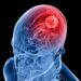 New Molecule Blocks Deadliest Brain Cancer at Its Genetic Root