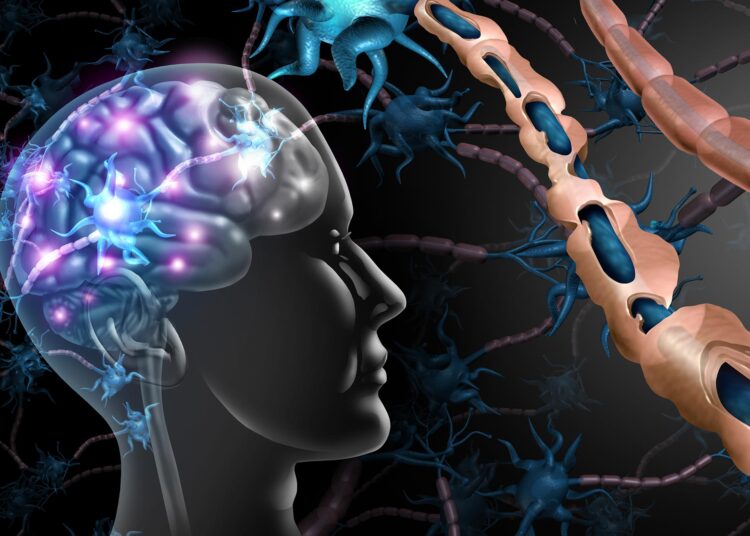 MS Could Begin More Than a Decade Before Symptoms – New Research Rewrites the Timeline