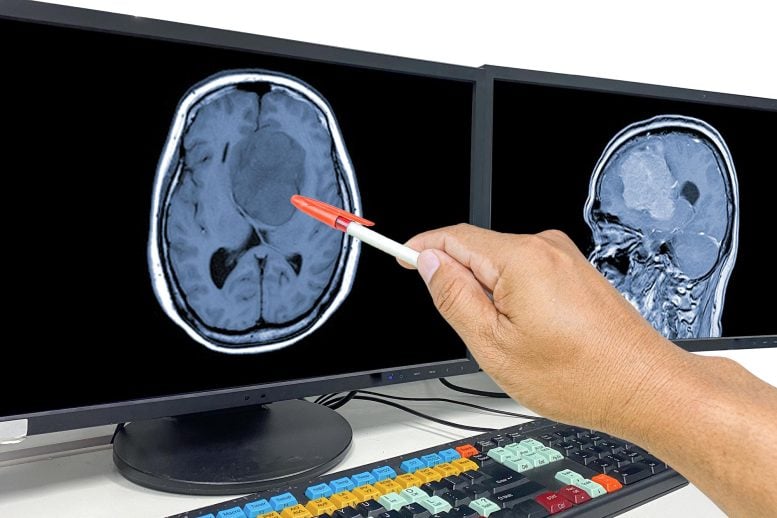 Glioblastoma Brain Cancer Tumor Metastasis MRI