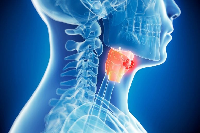 Throat Cancer Larynx Tumor Illustration