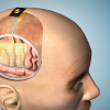 This illustration demonstrates how the thin film of sensors could be applied to the brain during surgery.